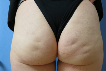Revolutionary Permanent Cellulite Treatment before 1268440