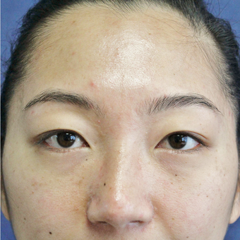 Asian Eyelid or Double Eyelid Surgery before 3776668