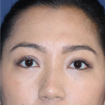 Asian Eyelid or Double Eyelid Surgery after 3776668