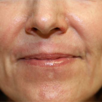 55-64 year old woman treated with Chemical Peel after 3837192