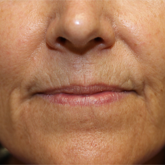 55-64 year old woman treated with Chemical Peel before 3837192