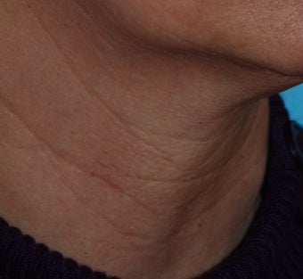 Before & After Fraxel Re:pair after 94107