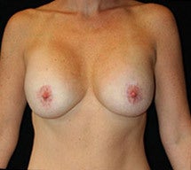 Breast Lift and Implants after 662458