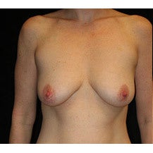 Breast Lift and Implants before 662458