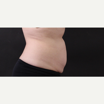 55 year old woman treated with CoolSculpting after 3220736
