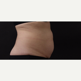 55 year old woman treated with CoolSculpting before 3220736