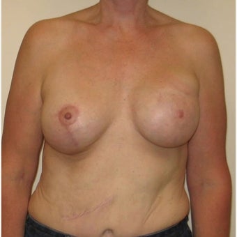 45-54 year old woman treated with Breast Reconstruction after 1622739
