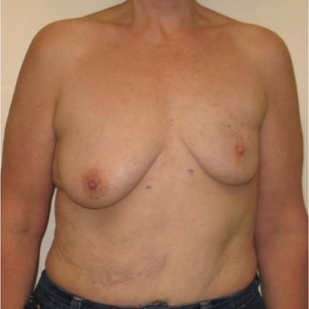45-54 year old woman treated with Breast Reconstruction before 1622739