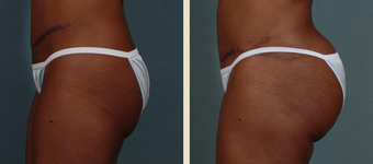 Butt Augmentation before 1376857