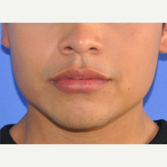18-24 year old man treated with Lip Augmentation after 3219175