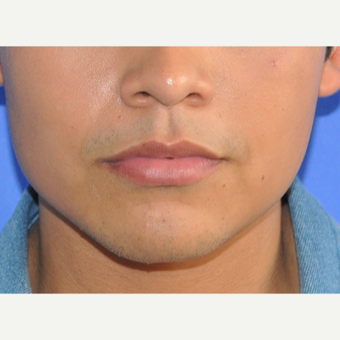 18-24 year old man treated with Lip Augmentation before 3219175