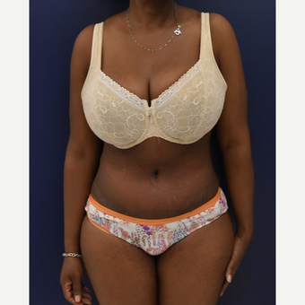 35-44 year old woman treated with Liposuction after 3033513