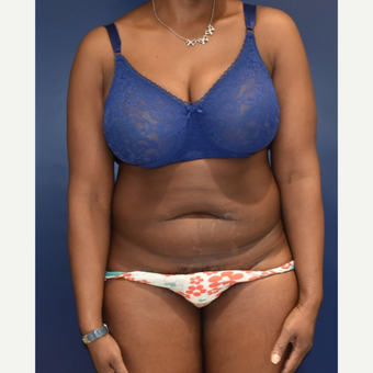 35-44 year old woman treated with Liposuction before 3033513