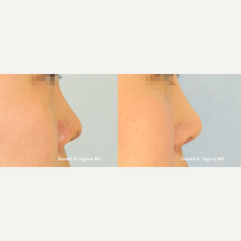 18-24 year old man treated with Asian Rhinoplasty using diced cartilage-fascia (DC-F) before 2858619