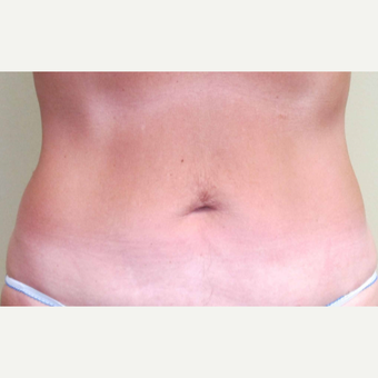 45-54 year old woman treated with Liposuction after 3305912