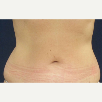 45-54 year old woman treated with Liposuction before 3305912