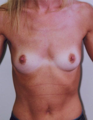 Breast Augmentation before 1302450