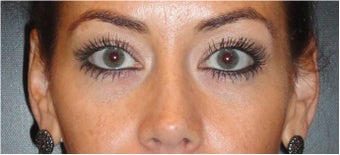 Restylane after 674591