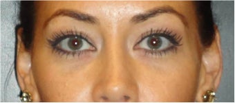 Restylane before 674591