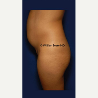 35-44 year old woman treated with Liposuction before 3803175