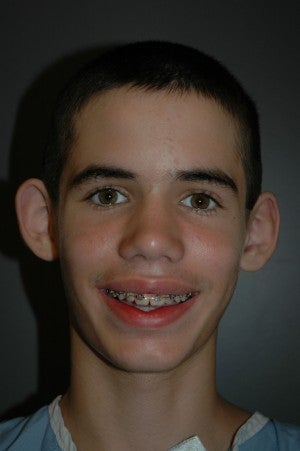 Bilateral otoplasty performed under local anesthesia and oral sedation. before 1432637