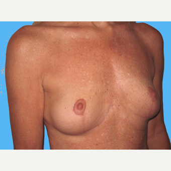 Breast Implant Removal after 3809807