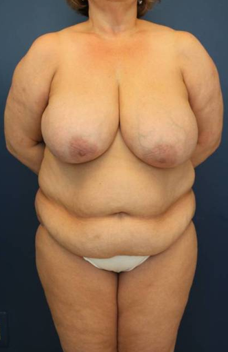 Body Lift before 1570763