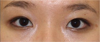 Double eyelid surgery for crease asymmetry after 3366891