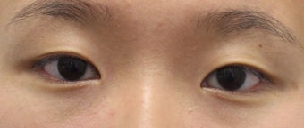 Double eyelid surgery for crease asymmetry before 3366891