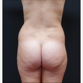 18-24 year old woman treated with Liposculpture before 3315562