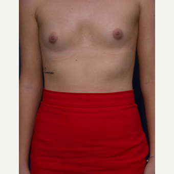 18-24 year old woman treated with Breast Augmentation before 3766932