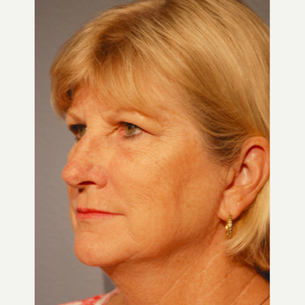 65-74 year old woman treated with Brow Lift before 3411624