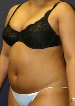 45-54 year old woman treated with Liposuction before 1670068