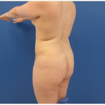 27 y/o female - 1500cc per side Lipo abdomen, flanks, back with fat transfer to the buttocks before 3433755