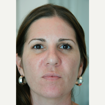 35-44 year old woman treated with Acne Treatment after 3287805
