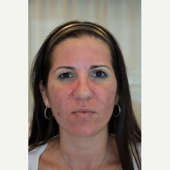 35-44 year old woman treated with Acne Treatment before 3287805