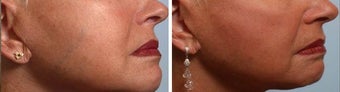 Sclerotherapy before 965496