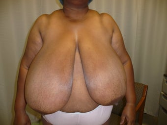 42 year old female who underwent Ultimate Breast Reduction before 632435