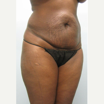 47 year old woman treated with Tummy Tuck before 3680126