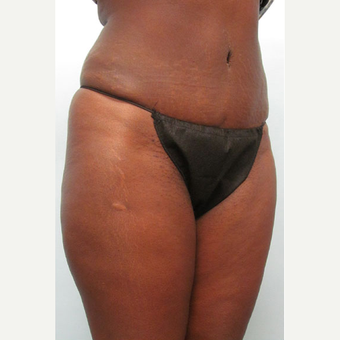 47 year old woman treated with Tummy Tuck after 3680126