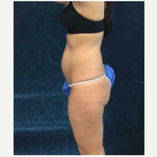 25-34 year old woman treated with CoolSculpting before 3181821