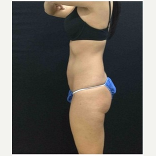 25-34 year old woman treated with CoolSculpting after 3181821