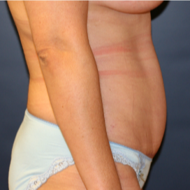 32 year old woman treated with Tummy Tuck after 3202993