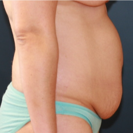 32 year old woman treated with Tummy Tuck before 3202993