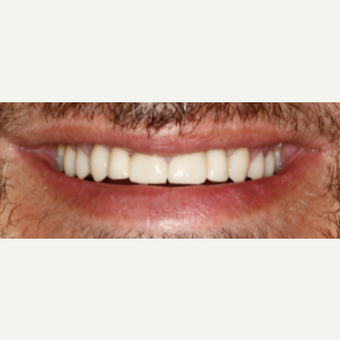 55-64 year old man treated with Smile Makeover after 3092347