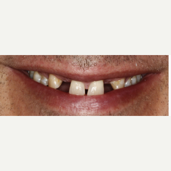 55-64 year old man treated with Smile Makeover before 3092347