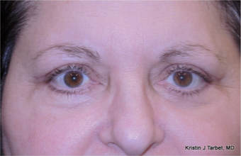 45-54 year old woman treated with Eye Bags Treatment after 3524482