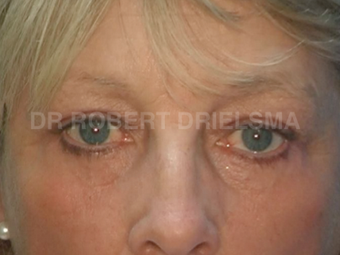 52yo woman, prominent eye bags (tear troughs) after 1513534