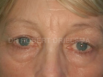 52yo woman, prominent eye bags (tear troughs) before 1513534