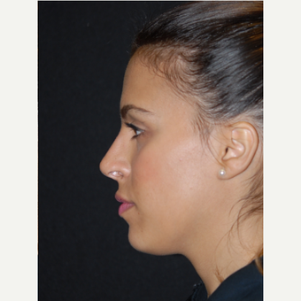 18-24 year old woman treated with Non Surgical Nose Job after 2728548